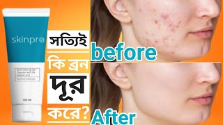 Does this face wash really remove acne? | skinpro acne clearing gel cleanser review screenshot 4
