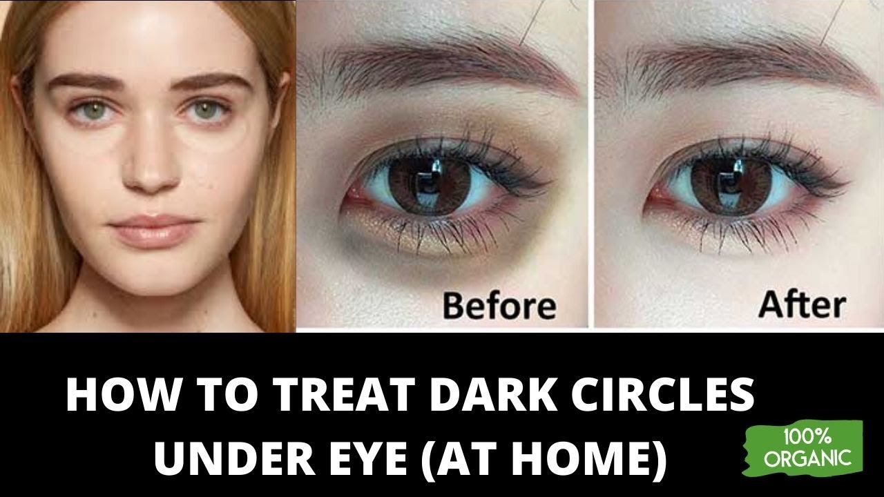 HOW TO TREAT DARK CIRCLES UNDER EYE AT HOME
