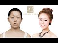 Korean Reconstructive Plastic Surgery Transformation | Seoul Guide Medical