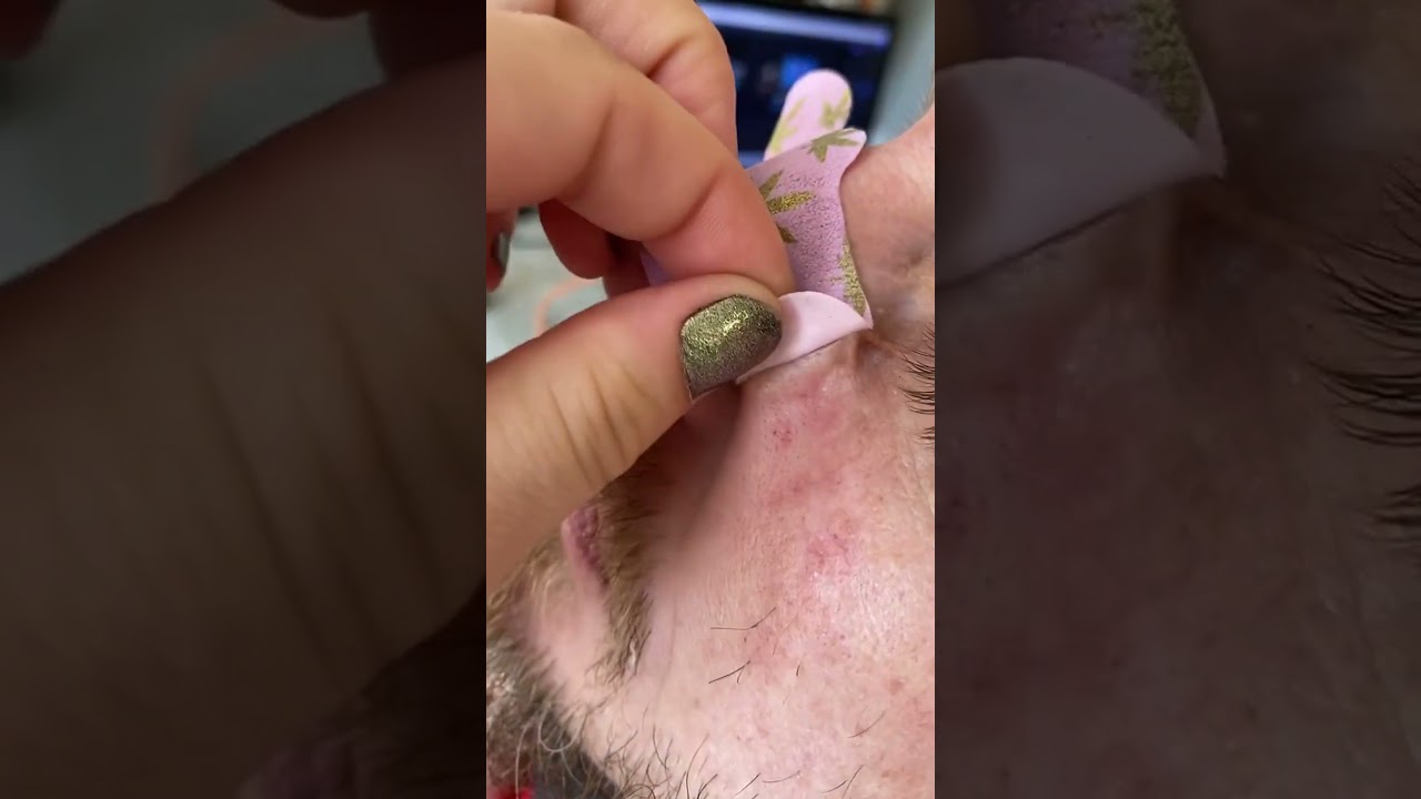 Satisfying Blackhead Removal: Nose Strip Results and Close-Up Extraction