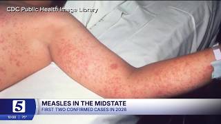 Middle Tennessee measles cases tied to Nashville, Murfreesboro sites