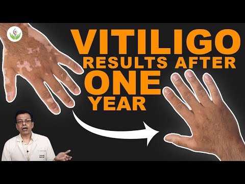 Video: Vitiligo - Syyt, Hoitomenetelmät