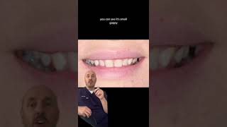 No Prep Veneers At Smiletexas