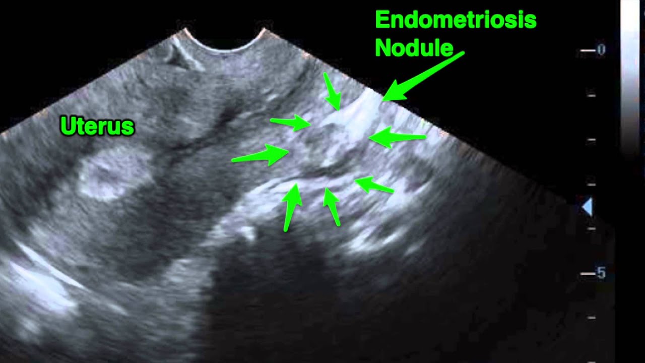 Узи признаки эндометриоза матки. УЗИ картина внутреннего эндометриоза. Наружный эндометриоз на УЗИ. Узловой эндометриоз по УЗИ.