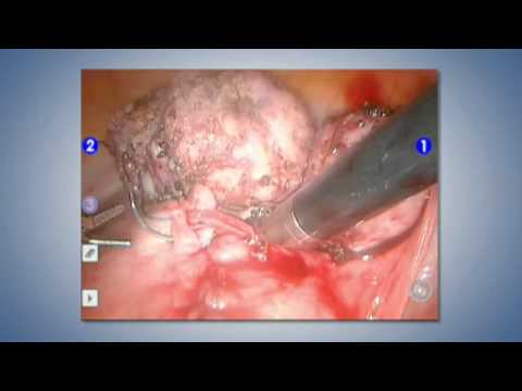 V-Loc™ Absorbable Wound Closure Device for Hysterectomy and Myomectomy Closure