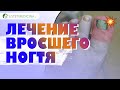 ВРОСШИЙ НОГОТЬ: КАК ЛЕЧИТЬ. 📹  Репортаж из кабинета подолога.