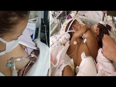 Doctor couldn&#39;t stop screaming when they realized how these twins were born.. Then This Happened