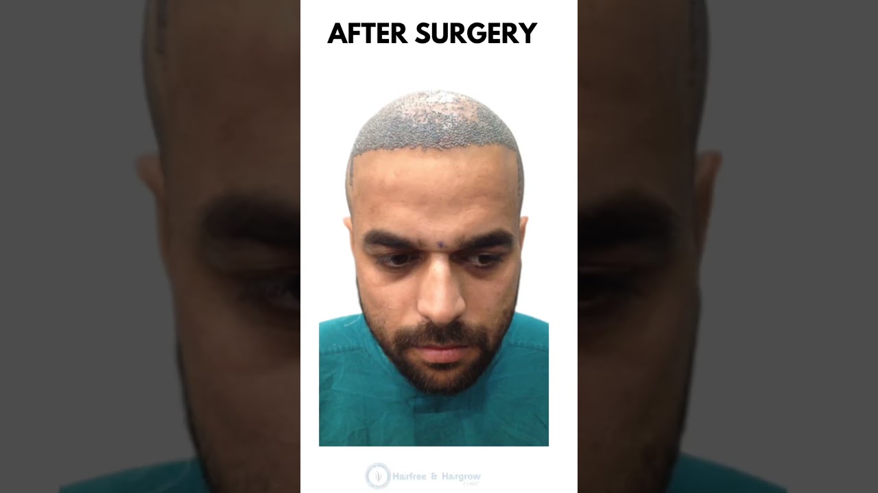Hair Transplant in Ahmedabad || hair transplant cost  || Hairfree and Hairgrow