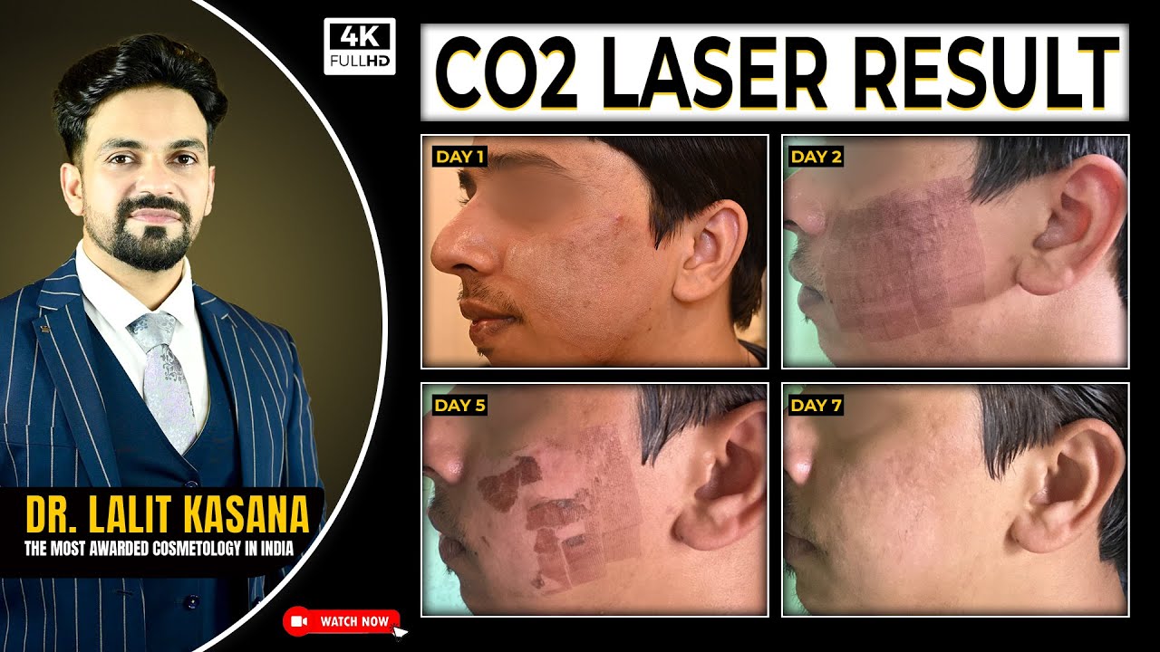 CO2 Laser Result II  CO2 Laser Treatment for Acne Scars  | Before After Results |