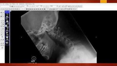 Loss of Motion Segment Integrity - Cervical Spine  Perry J. Carpenter DC QME, www.ezqmeceu.com