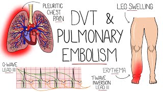 Deep Vein Thrombosis (DVT) & Pulmonary Embolism Explained