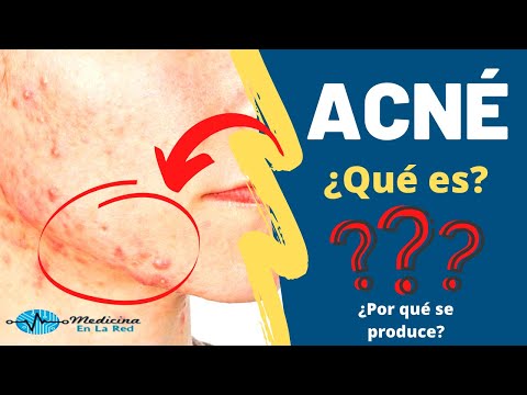 ACNÉ: ¿Qué es?