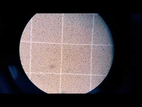 Video: Ar Daliniai AZFc Išbraukimai Turi įtakos Spermatozoidų Išgavimo Greičiui Kosafelterio Nemosozavusiems Pacientams, Kuriems Atliekamas Sėklidžių Spermos Išskyrimas Mikrotipais?