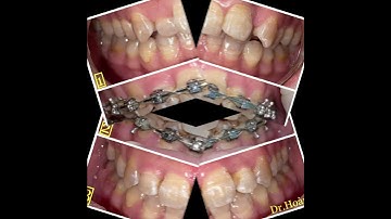 Sau 15 tháng niềng bằng mắc cài Damon Q 🥰