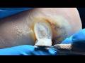 Careful! Repair the extremely thick plantar warts on the soles of the feet!