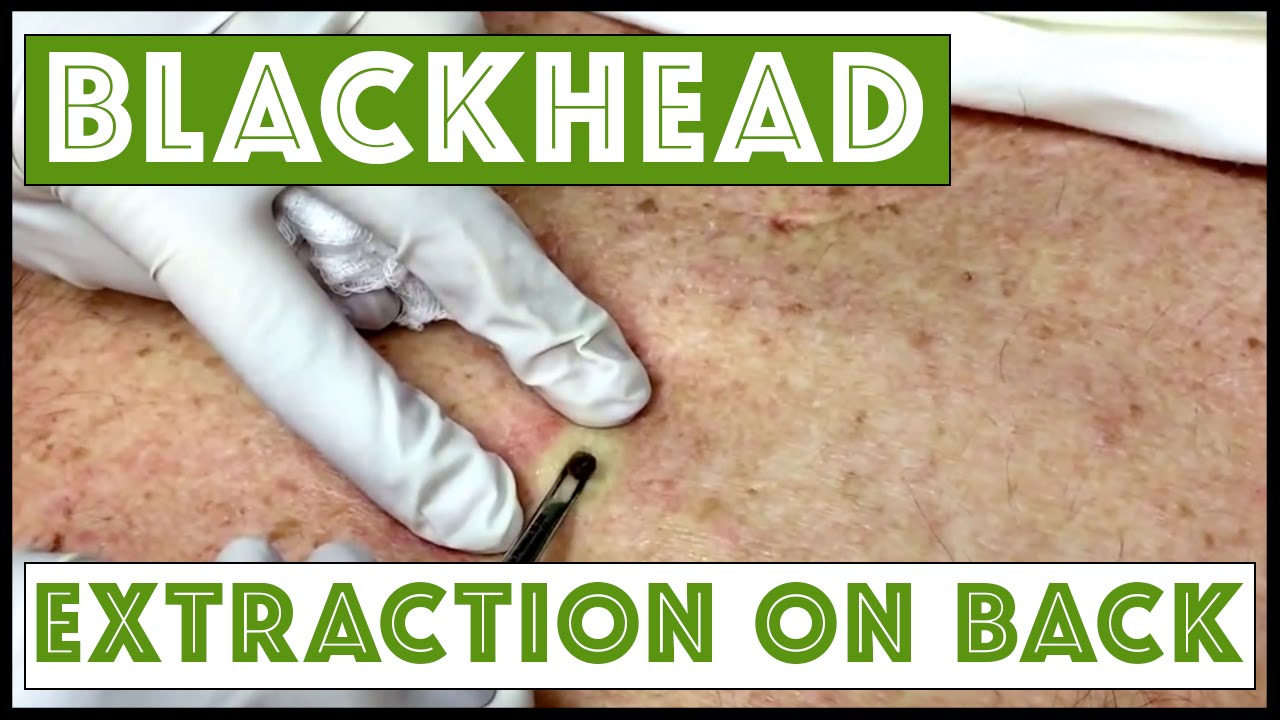 Updated Blackhead Cyst X Extraction On The Back For Medical Education NSFE YouTube