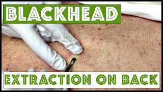 Updated blackhead cyst x2 extraction on the back  For medical education- NSFE.