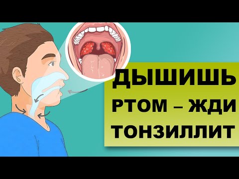ХРОНИЧЕСКИЙ ТОНЗИЛЛИТ: как заложенность носа усугубляет болезнь
