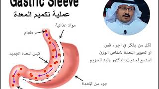 لقاء اذاعي ، عملية ، قص المعدة ، تكميم ، ايجابيات ، خطوات، سلبيات ، اضرار ، مخاطر ، مضاعفات ، مشاكل