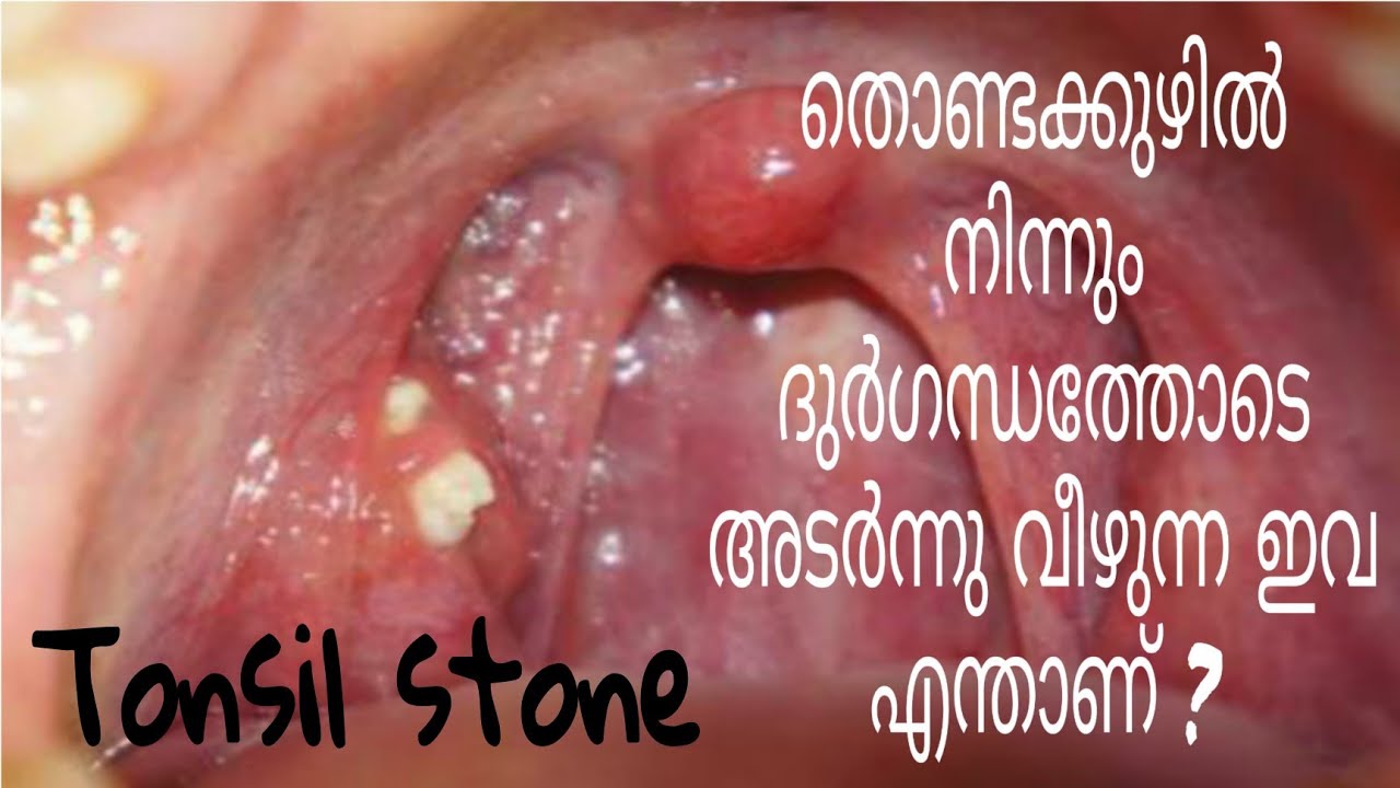 Tonsillitis / tonsilstone / home remedies & prevention / tonsilstone
