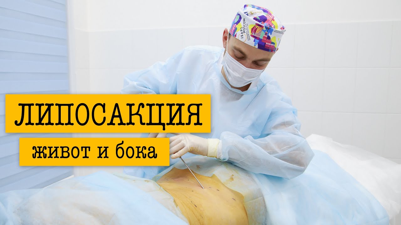 Липосакция в Санкт-Петербурге - YouTube