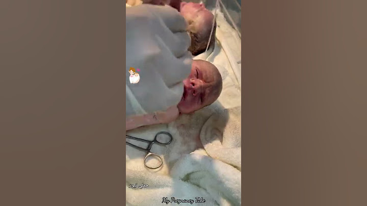 ولادة توأم  بنات ما شاء الله 💙