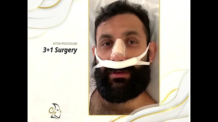 Rhinoplasty Before and After with Dr  Marc Mueller