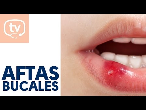 Vídeo: ¿Son Las Aftas El Herpes?