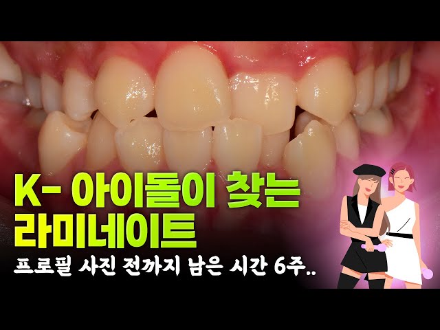 K-아이돌 라미네이트, 남은 시간은 단 6주❗❗❗