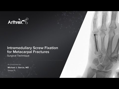 Videó: Mikor kell műtétre a kézközépcsont-töréseknél?