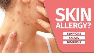 What is Skin Allergy? Symptoms, Causes, Diagnosis and Triggers