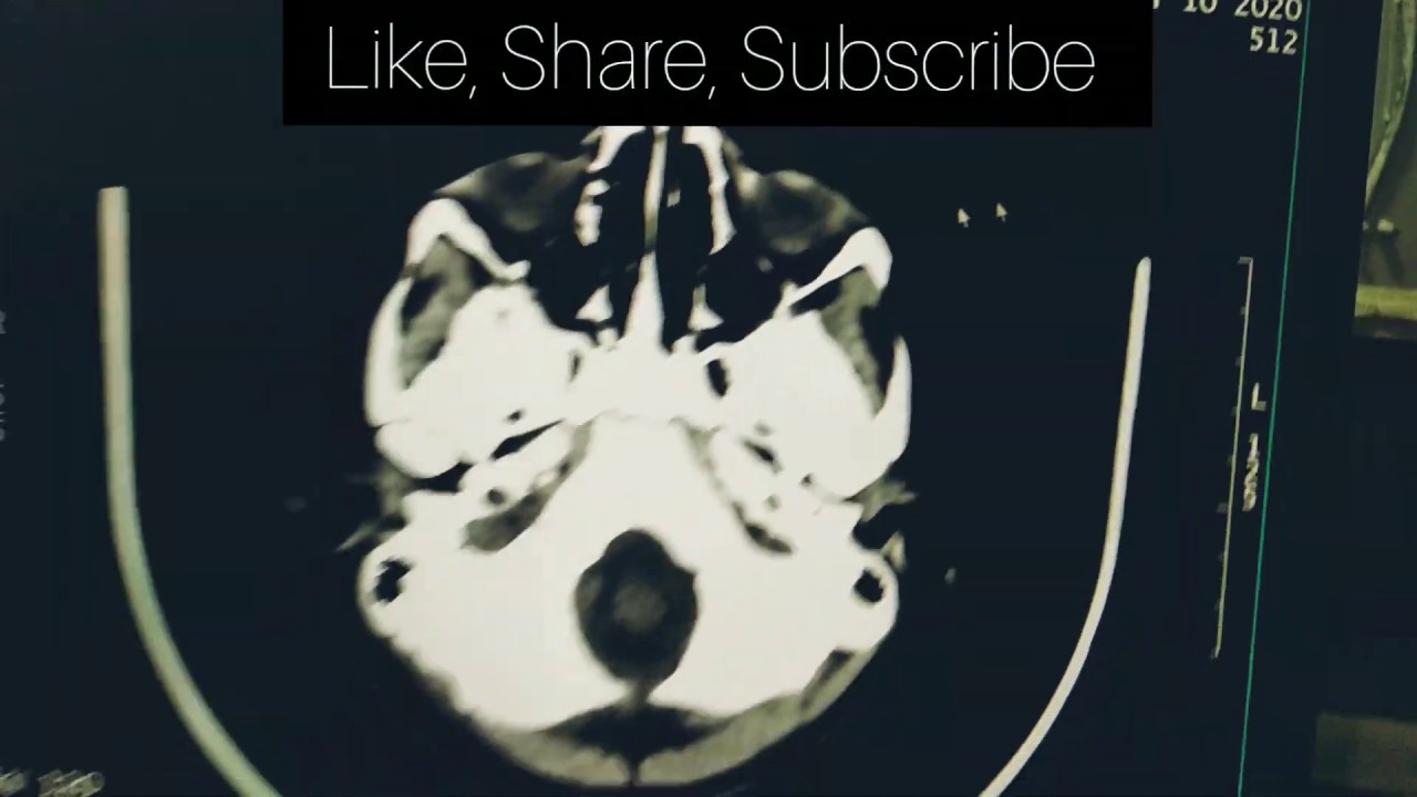 Filming Of CT Scan Head With Bonewindow On GE Scanner in 6×7 Format.