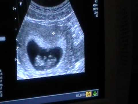 test weeks 9 pregnancy positive 10 week ultrasound YouTube test weeks 9 pregnancy positive 10 week ultrasound YouTube