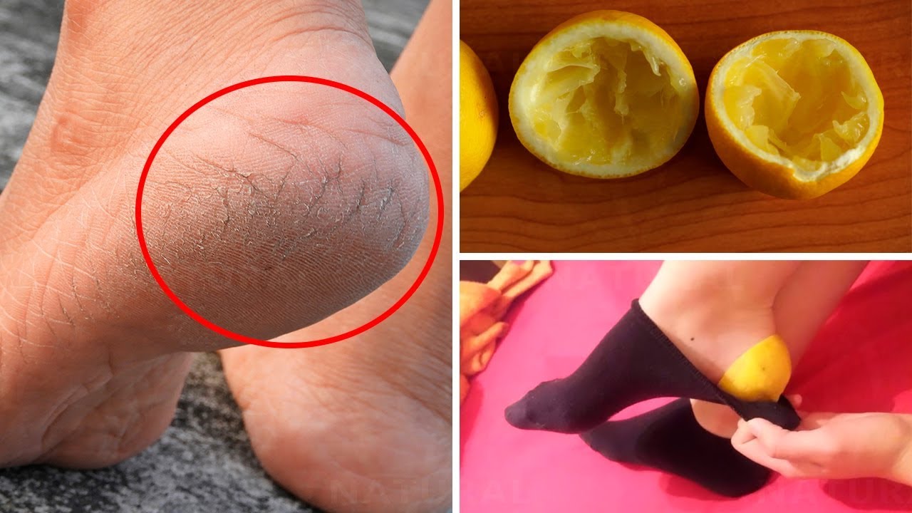 Put Your Best Foot Forward: 10 home remedies to help cracked heels