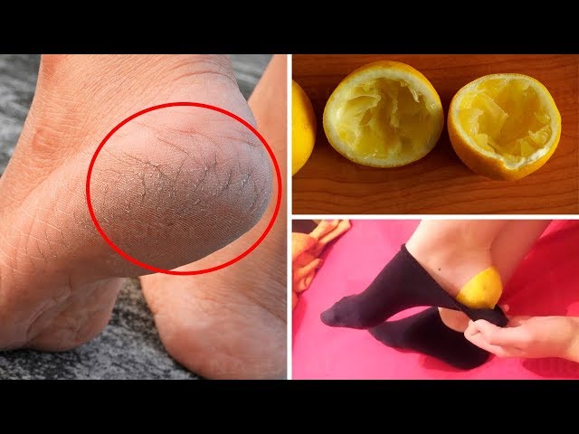 Simple And Easy ways to Cure Cracked Heel at Home