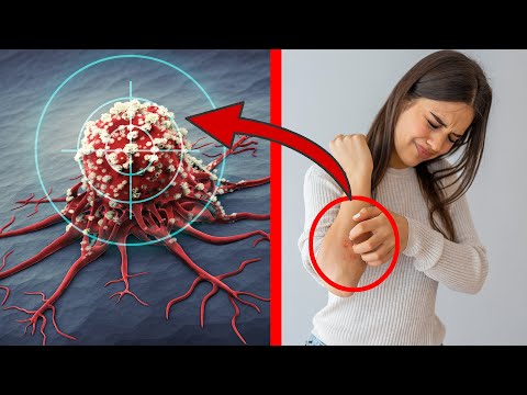 Video: Welche Lymphknoten schwellen bei Schilddrüsenkrebs an?