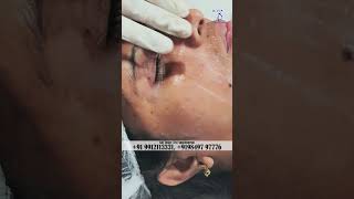 Treatment for Pigmentation on Face || Skin Care || Dr. VJs Cosmetic Surgery & Hair Transplantation