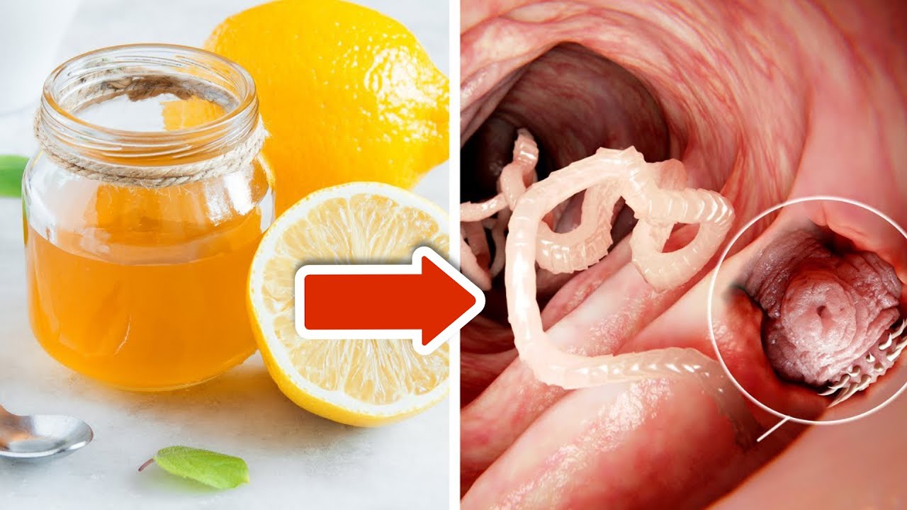 Mische Zitronenschale mit Honig um Darmwürmer zu beseitigen💥(Klappt ... Mische Zitronenschale mit Honig um Darmwürmer zu beseitigen💥(Klappt ...