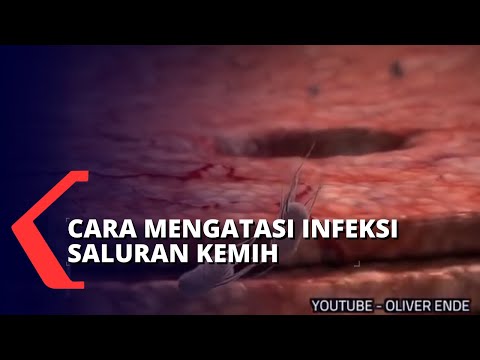 Video: Cara Menggunakan Pemindai Kandung Kemih: 8 Langkah (dengan Gambar)