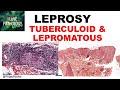 LEPROSY: etiopathogenesis, classification. Tuberculoid & lepromatous leprosy
