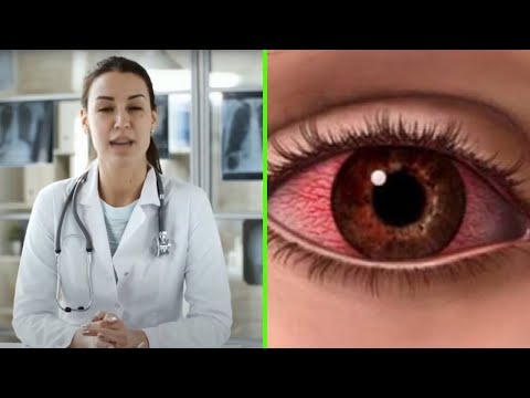 Vídeo: Artrite Psoriática E Seus Olhos: Sintomas E Muito Mais