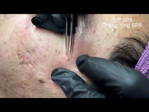黑頭粉刺清除紀錄(太陽穴旁) Blackhead Removal (Beside the Temple)
