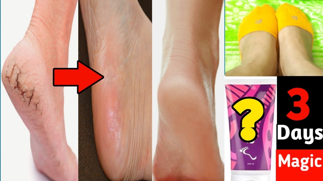 Cracked Heels Treatment | Best Foot Cream For Cracked Heel | Amway Foot Cream | Amway Products