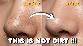 How to ACTUALLY clear Blackheads & Whiteheads || The Science & The Fix || No BS Skincare