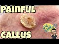 SATISFYING CALLUS REMOVAL FROM FEET