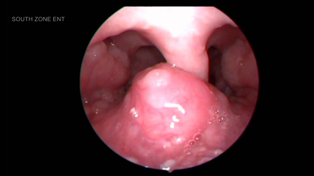 Pharyngeal tonsils - remove or treat Pharyngeal tonsils - remove or treat