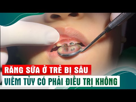 Video Chữa tủy răng sữa bị sâu cho bé trai dũng cảm - youtube