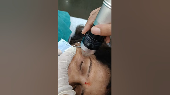 Dark circles treatment by MNRF technology.. Message me  99908 04088.