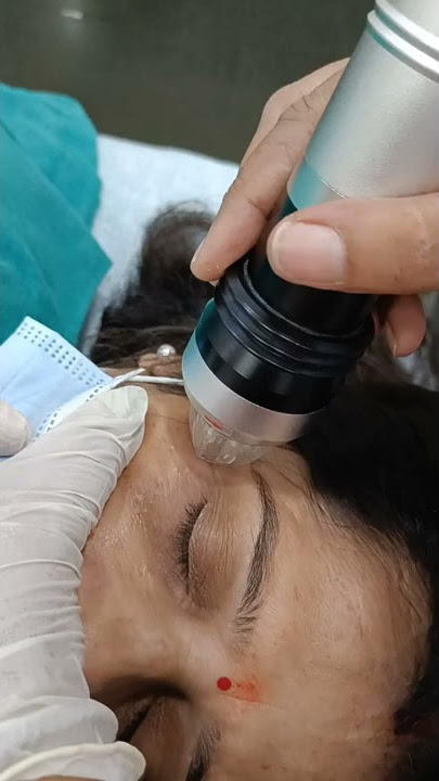 Dark circles treatment by MNRF technology.. Message me  99908 04088.