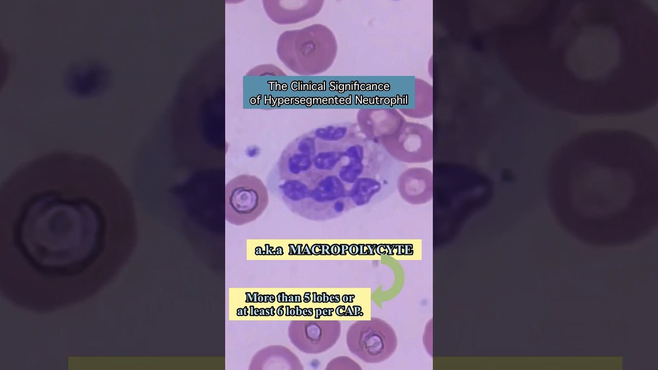 What is a Macropolycyte or Hypersegmented Neutrophil? 